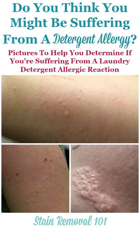 Apply a small amount of the product on your inner forearm or behind your ear and observe for any adverse reactions over 24-48 hours. . Photos of allergic reaction to laundry detergent